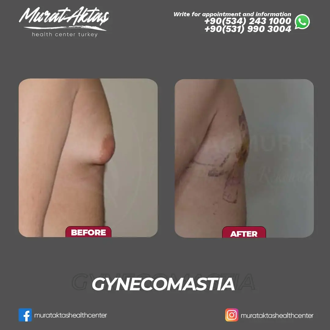 Gynecomastia