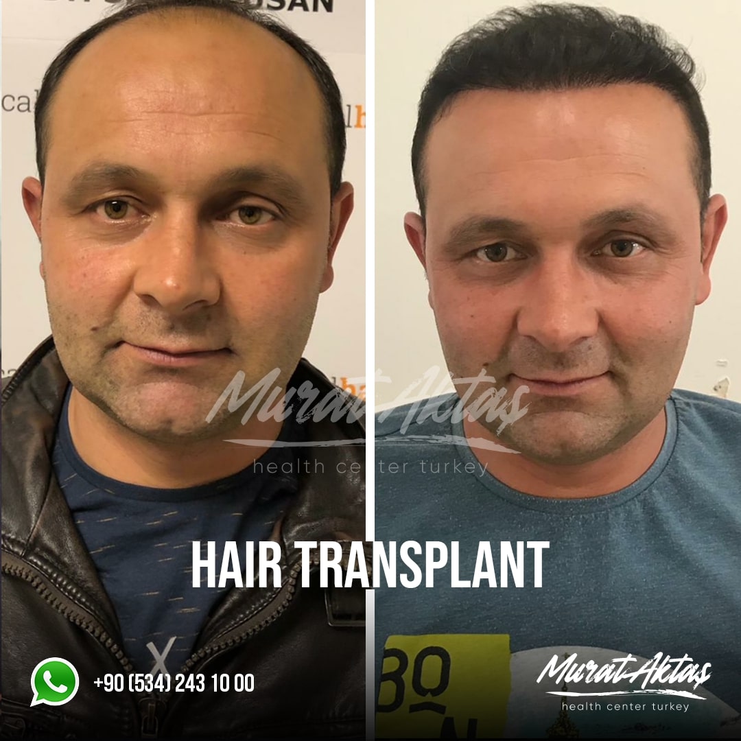 Hair Transplant