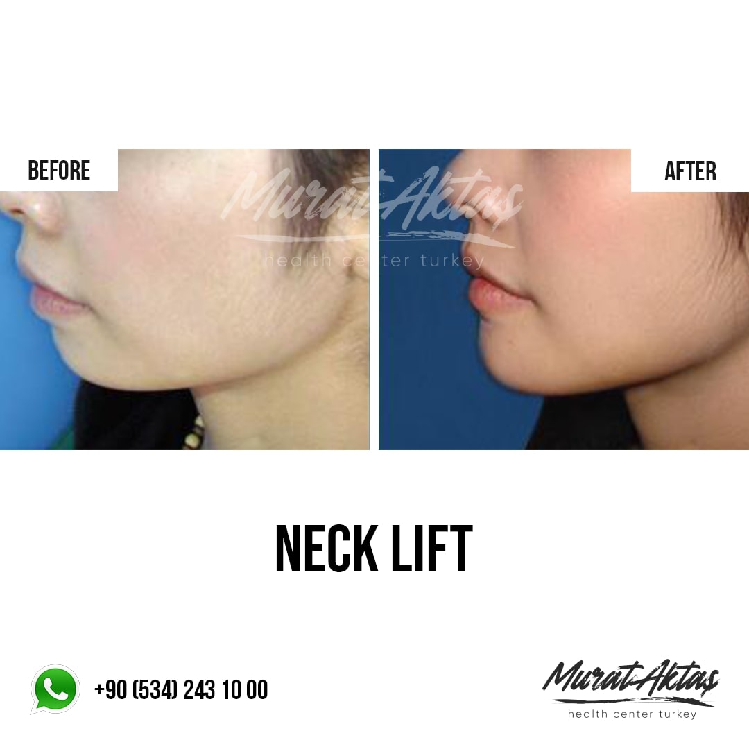 Neck Lift