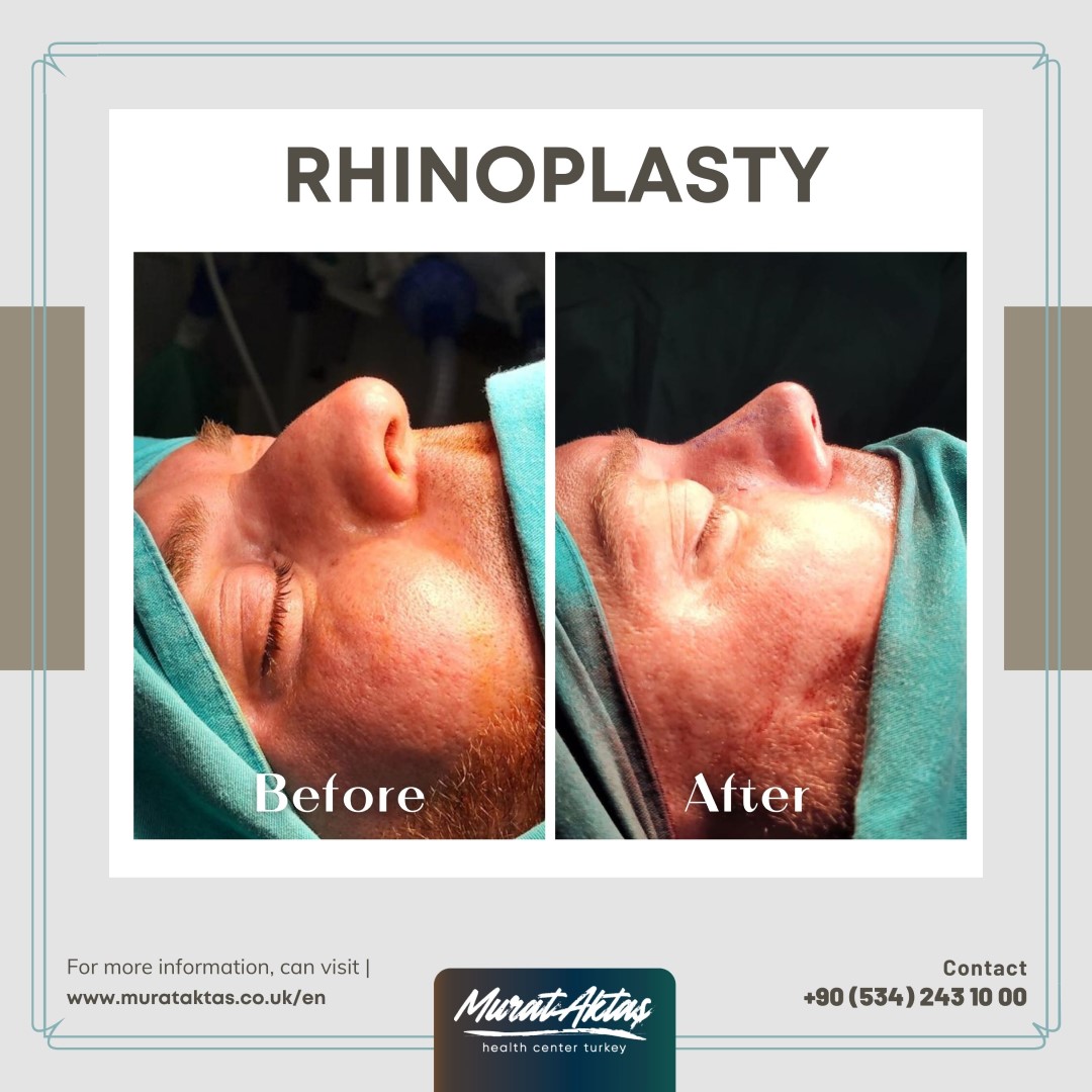 Rhinoplasty