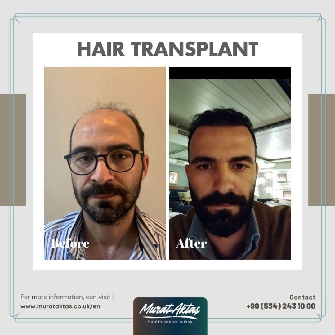 Haartransplantation7