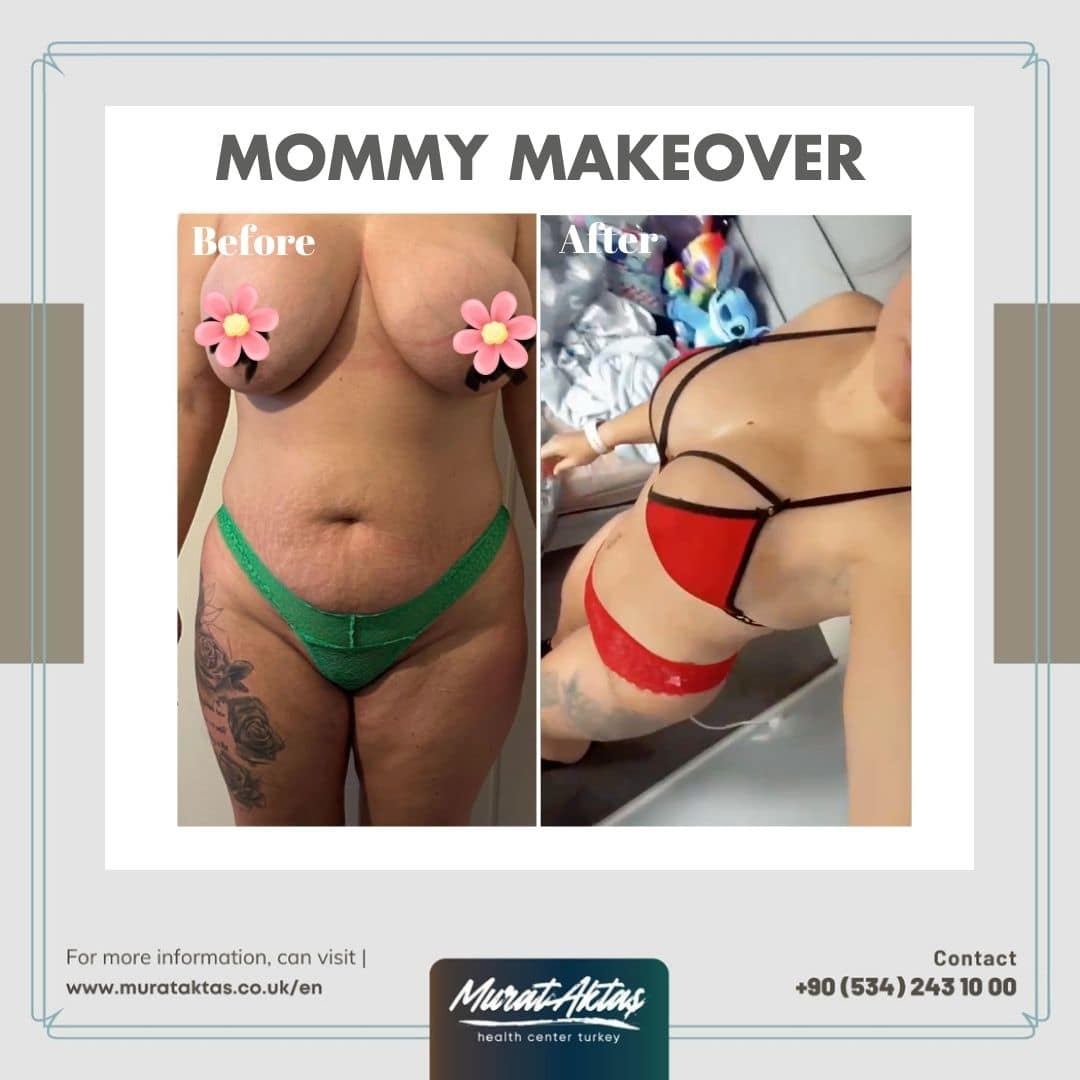 Mommy Makeover Bild 2023-08-11 um 15.50.00 (6)