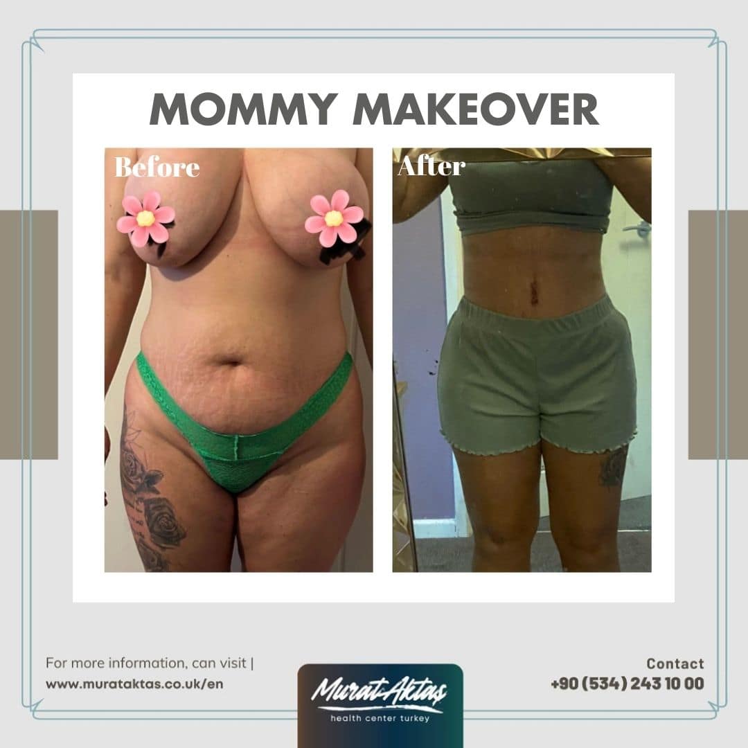 Mommy Makeover Bild 2023-08-11 um 15.50.00 (8)