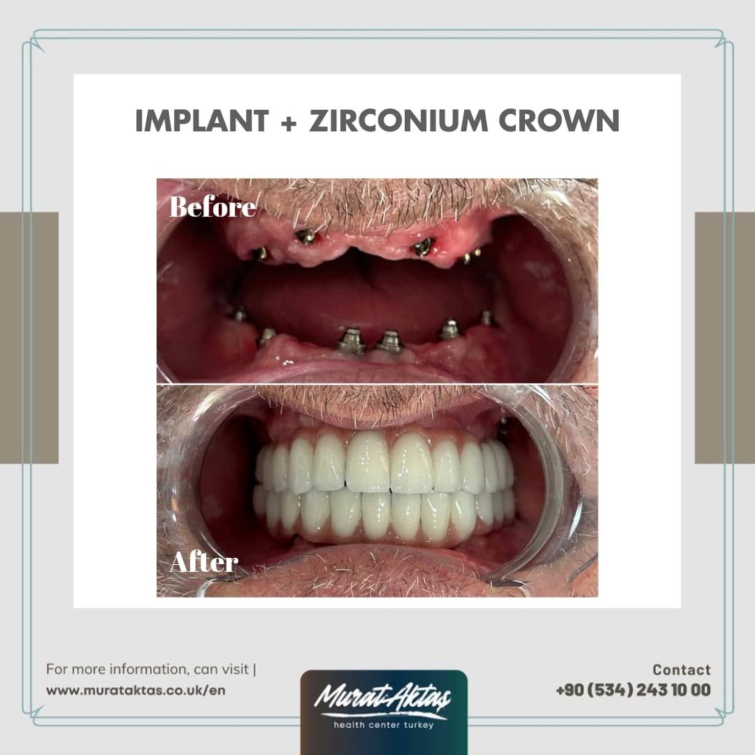 Implant