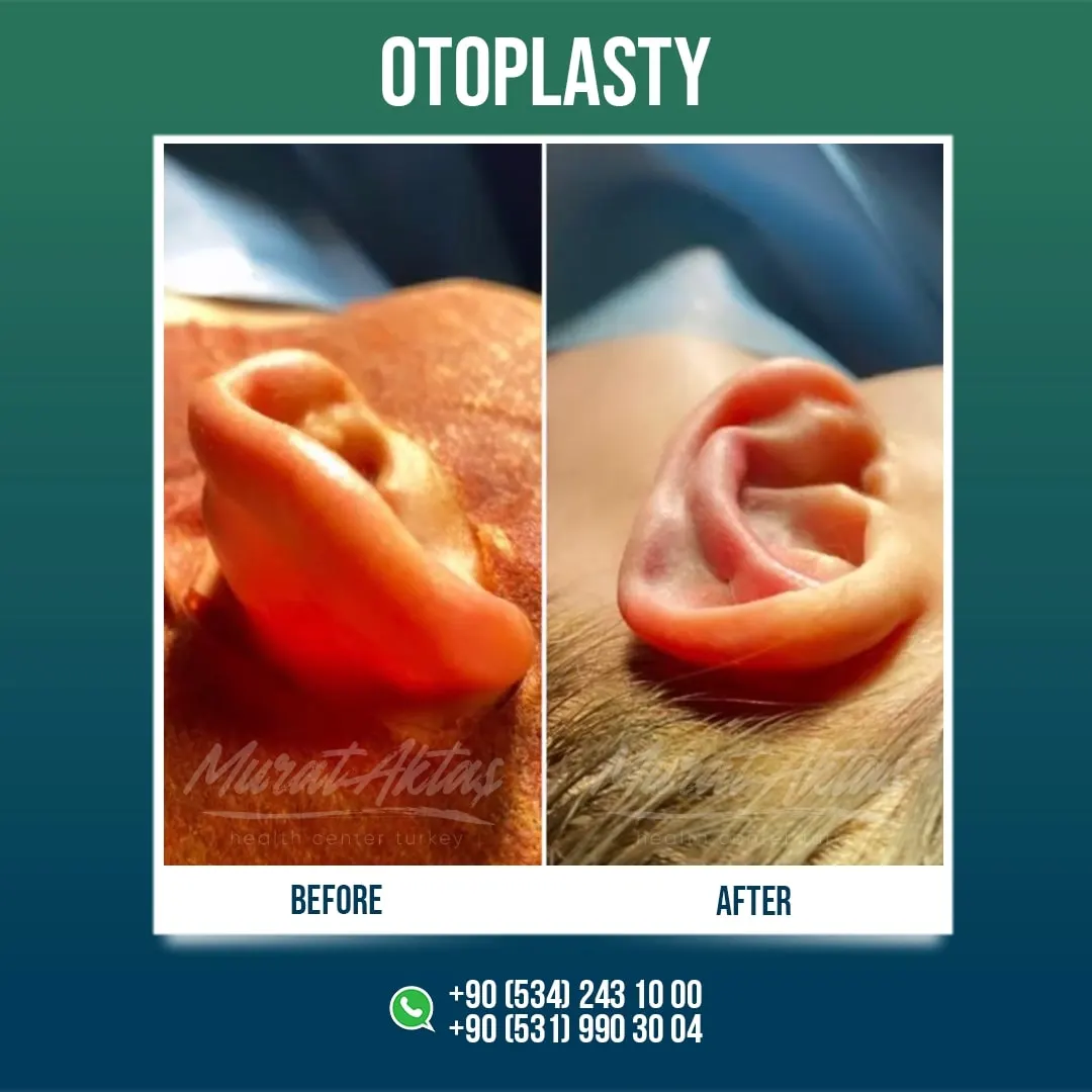 Otoplasty