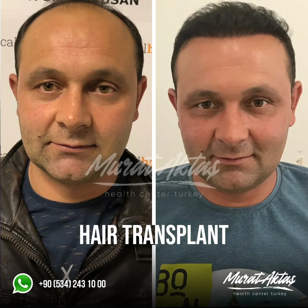 Hair transplant