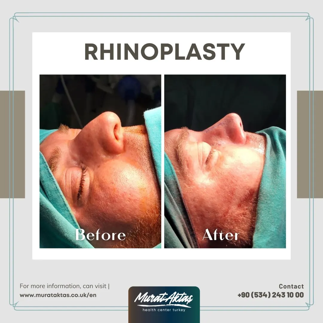 Rhinoplasty