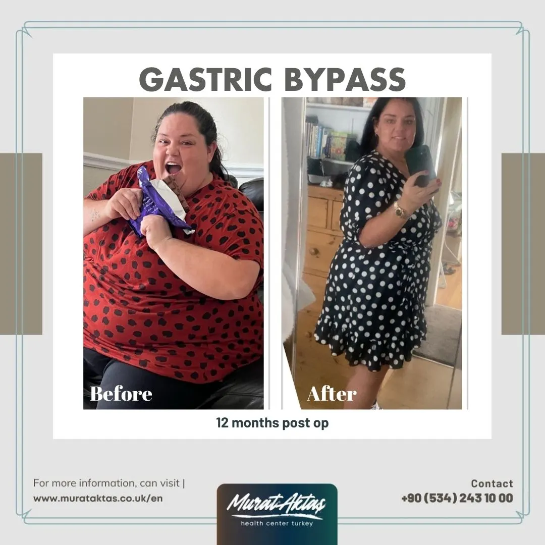 GASTRIC BYPASS
