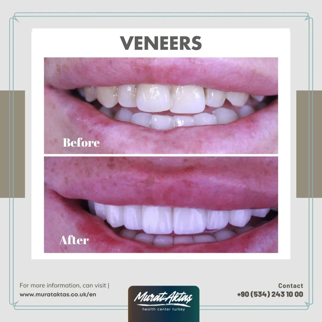 Veneers